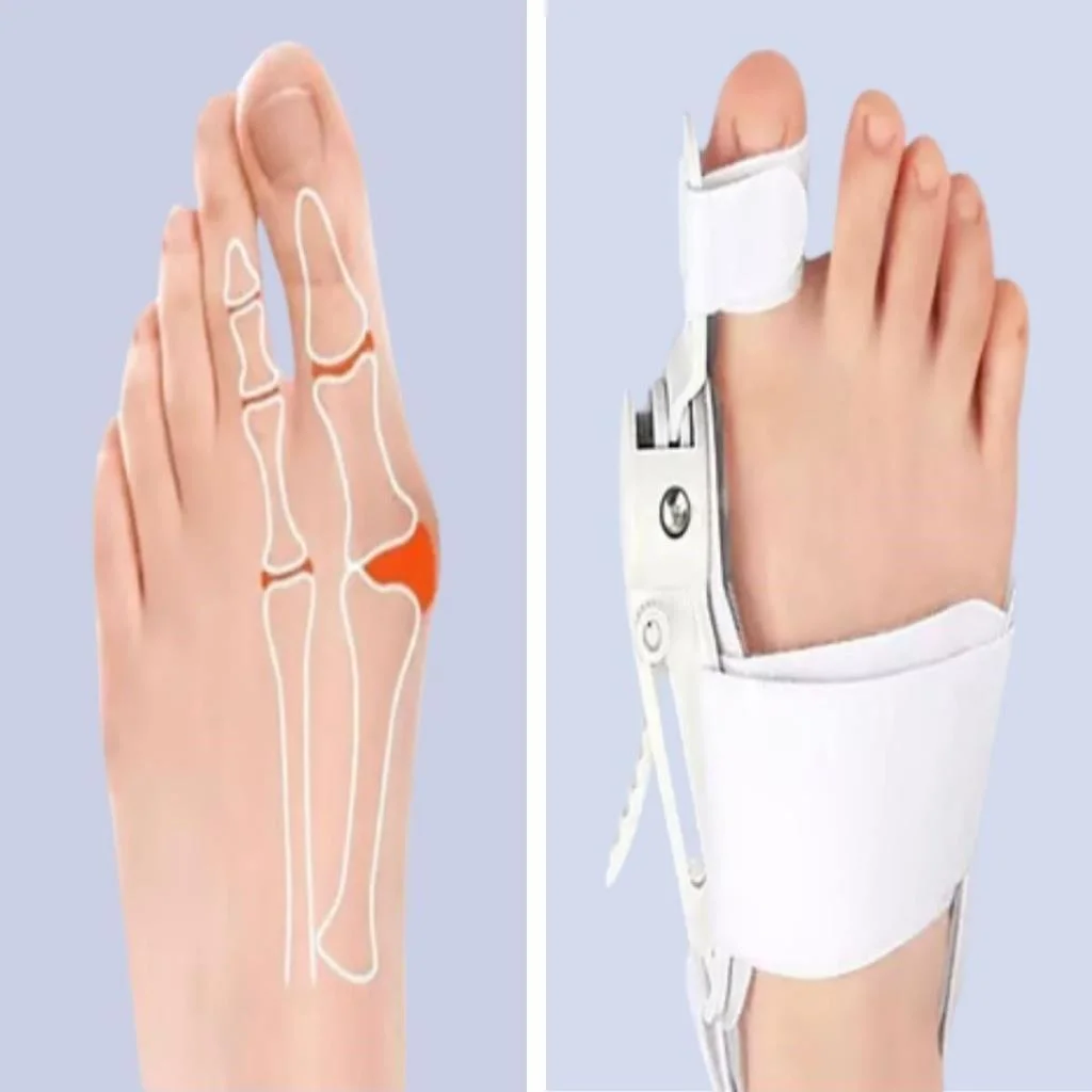 Ayarlanabilir Ayak Baş Parmak Kemik Düzeltici – Halluks Valgus (Bunyon) Aparatı, Gece Gündüz Kullanıma Uygun Ayak Düzeltme Ateli görsel 3