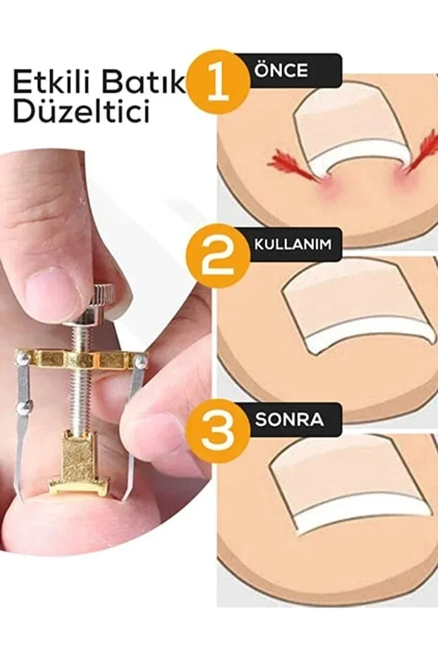 Batık Tırnak Çıkartıcı Çelik Batan Tırnağı Düzeltme Aparatı Düzeltici Aleti Çıkarıcı Aparat